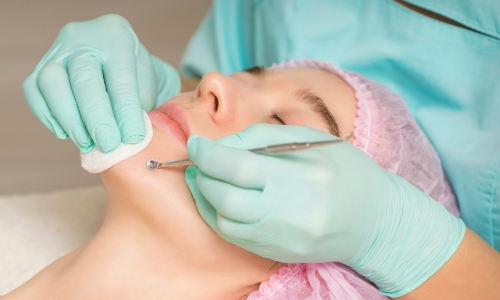 best acne facial colorado springs